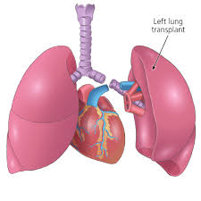 Lung Transplant